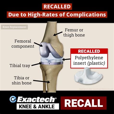 exactech recall 2022.
